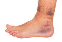 A sprained ankle
